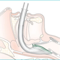 i-gel® Supraglottic Airways - Image 2