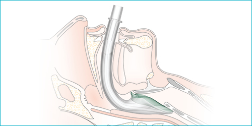 i-gel® Supraglottic Airways - Image 2